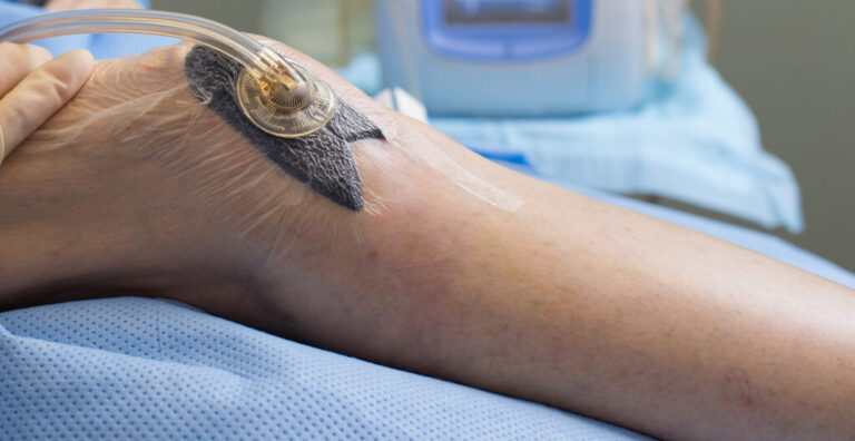 A Prospective Randomized Clinical Trial of Vacuum Therapy Device Versus Occlusive Dressing for Wound Care