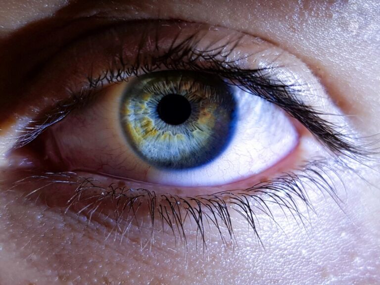 Mini-Review Article : Retinopathy in Cerebral Malaria