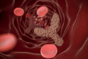 Functional Oncocytic Adrenocortical Tumour: A Rare Case Report